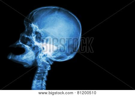 X-ray Skull Open Mouth ( Side View ) And Stroke ( Cerebrovascular Accident ( Cva ) )