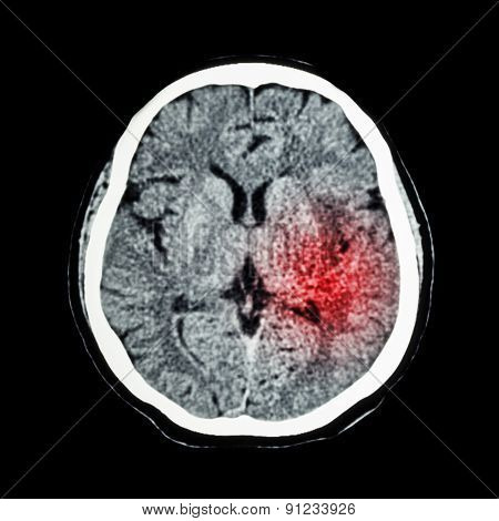 Ct Scan Of Brain Show Ischemic Stroke Or Hemorrhagic Stroke