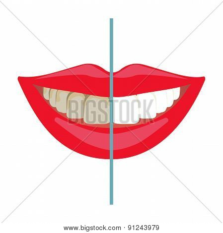 Teeth whitening before and after