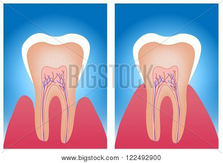 hypersensitive teeth and normal teeth on blue background