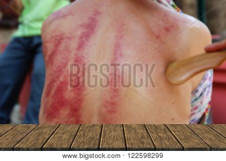 People Demonstrate Guasa Method Which Is The Alternative Medicine For Skin Detoxifying On Man's Back