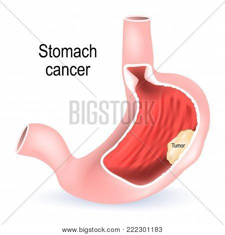 Stomach cancer. Cross section of the stomach with tumor inside