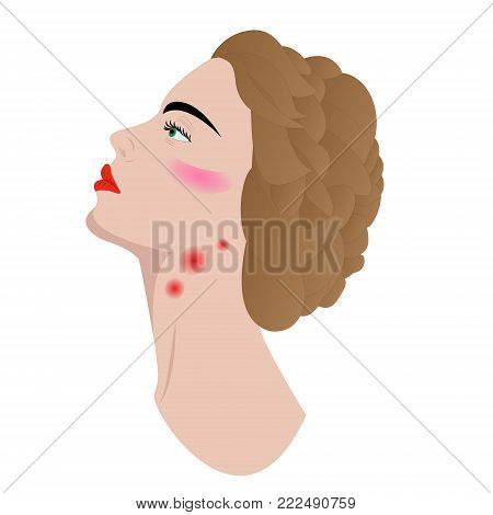 Swollen lymph nodes in woman's neck  on a white background