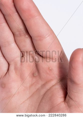 A flat wart commonly found on the hands and feet of children and young adults. They are caused by a type of human papillomavirus HPV