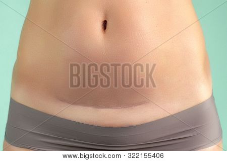 Close Up Of A Caesarean Section Scar In A Woman. Health And Childbirth