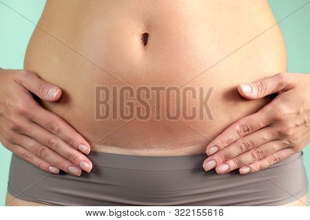 Close Up Of A Caesarean Section Scar In A Woman. Health And Childbirth