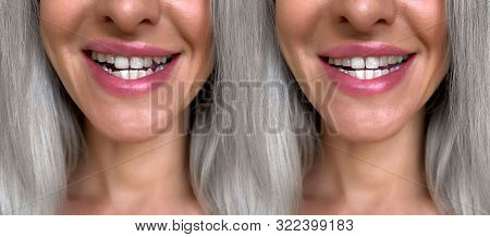 Alignment And Correction Of Tooth Defects.