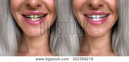 Teeth Whitening