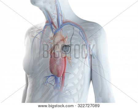 3d rendered illustration of an old man with a pace maker