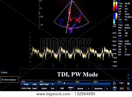 Colourful Ultrasound Monitor Image. Tdi, Pw Mode
