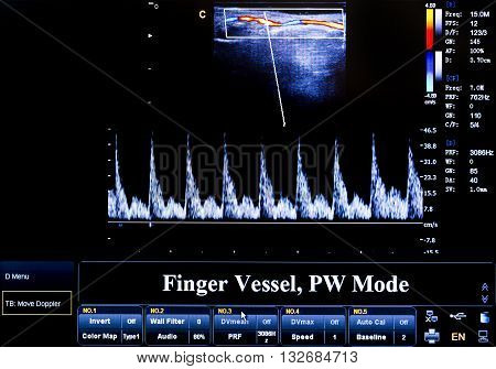 Colourful Ultrasound Monitor Image. Finger Vessel