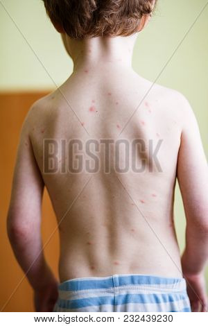 Baby With Chicken Pox Rash. Varicella Virus Or Chickenpox Bubble Rash On Child. Dermatology Concept.