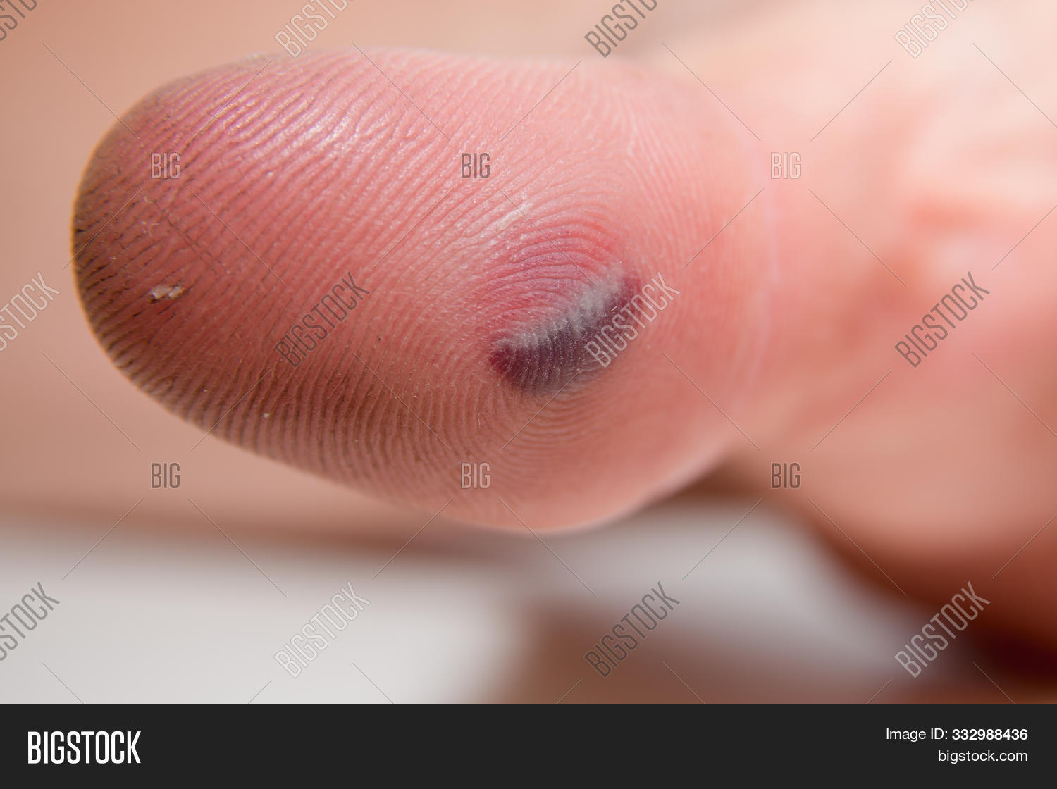 Wallpaper Blood Blister Under Image Photo Free Trial Bigstock For Android Free
