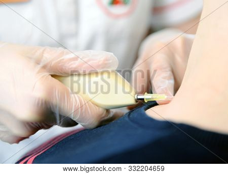 Carbon Dioxide Therapy (carboxytherapy). Skin Rejuvenation.skin Rejuvenation Procedure