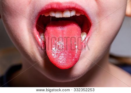 Tongue Of A Child With Scarlet Fever - Strawberry Tongue
