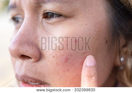 Close Up Of Women Freckle, Dark Spot On Face, Dried Skin Issues, Need Treatment. Asian Middle Age Wo