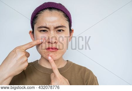 Asian Woman Pointing To Acne Inflamed On Her Face. Inflamed Acne Consists Of Swelling, Redness, And 