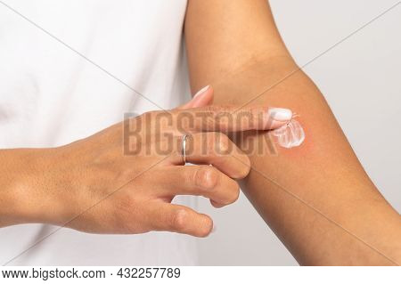 Allergic Reaction, Itch, Allergy, Dermatiti Concept. Close Up Of Woman Applying Cream Or Ointment On