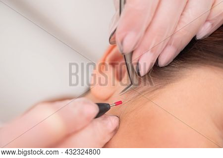Woman On Electro-epilation Of The Face. Hardware Permanent Removal Of Unwanted Hair In The Salon