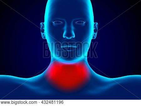 Pharyngitis Is An Infection Of The Pharynx Caused By Bacteria Of The Genus Streptococcus. 3d Renderi
