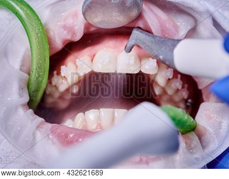 Close Up Of Orthodontist Using Dental Tools While Cleaning Teeth Of Patient. Woman With Cheek Retrac
