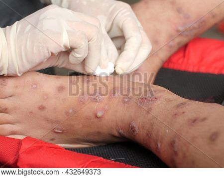 Close Up Of Nurse Hand Cleaning Patient Foot With Ulcer Filled With Pus Condition Caused Of Scabies 
