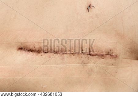 Surgery On The Hip. Postoperative Suture On The Skin With Iodine. Un Stitched Up Skin After An Opera