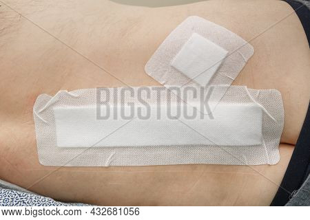 Postoperative Suture Sealed With A Plaster After Spinal Surgery