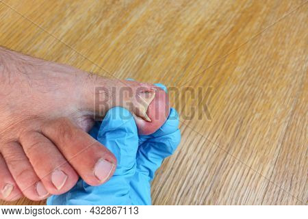 Ingrown Toenail On Foot. Doctor Examines Thumb.