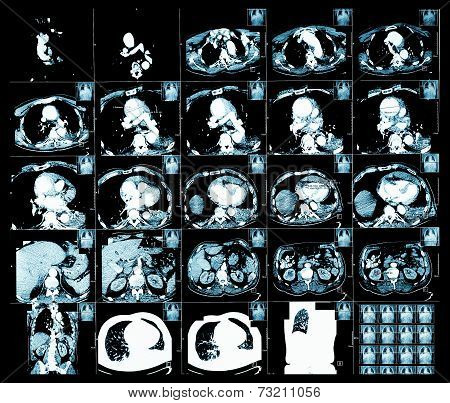 Computed Tomography Of Thoracic Segment
