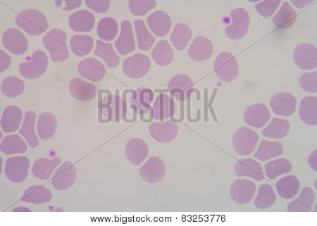 Red Blood Cells Form Macrocytosis.