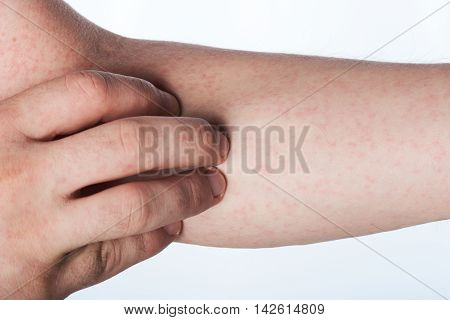 Close Up Of Hand With Rash