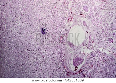 Acute Glomerulonephritis, Light Micrograph, Photo Under Microscope