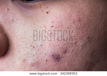 Ugly Pimples Blackheads On Cheek Face Of Teenager