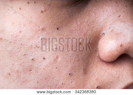 Ugly Pimples Blackheads On Cheek Face Of Teenager