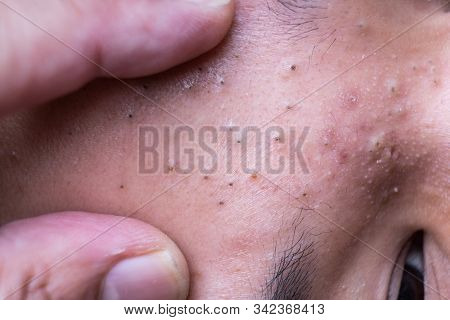 Finger On Ugly Pimples Blackheads On Face Of Teenager