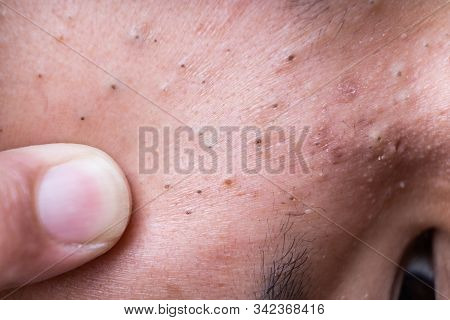 Finger On Ugly Pimples Blackheads On Face Of Teenager