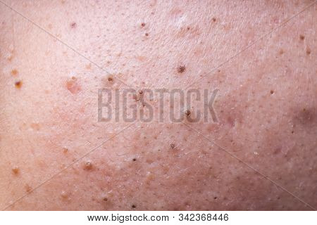 Ugly Pimples Blackheads On Face Of Teenager Neglected Of Facecare