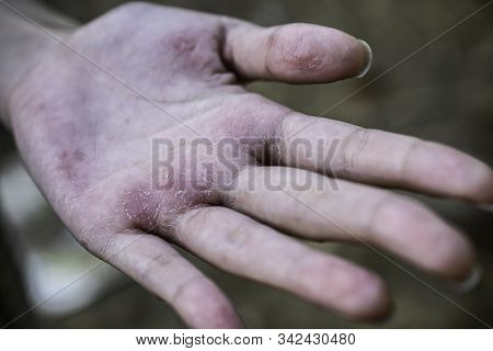 Skin Healthy Care. Seborrheic Dermatitis On Hand In Young Woman.