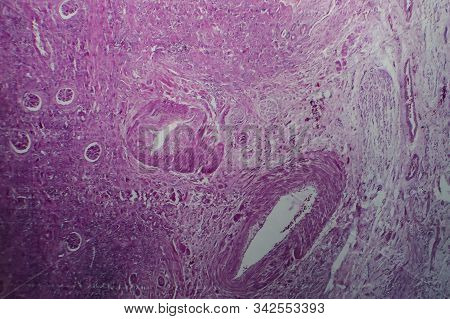 Chronic Glomerulonephritis, Light Micrograph, Photo Under Microscope