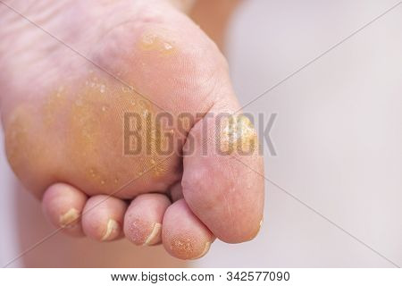Warts And Corns On A Womans Foot. Dermatology Disease. Plantar Warts. At The Appointment With A Derm