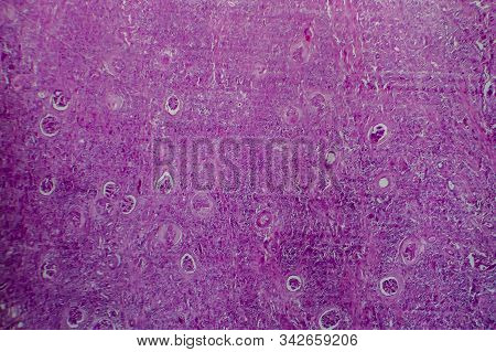 Chronic Glomerulonephritis, Light Micrograph, Photo Under Microscope