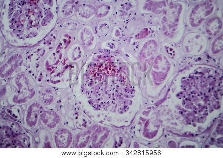 Acute Glomerulonephritis, Light Micrograph, Photo Under Microscope