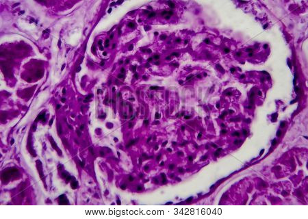 Diffuse Proliferative Glomerulonephritis, Dpgn, Light Micrograph, Photo Under Microscope. High Magni