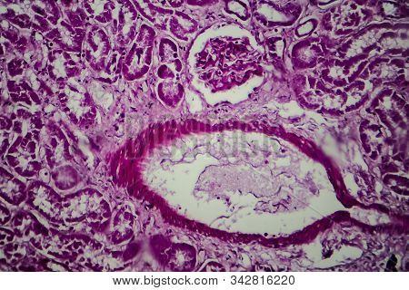Histopathology Of Diffuse Sclerosing Glomerulonephritis, Light Micrograph, Photo Under Microscope