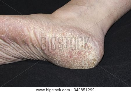Foot With Rough And Scaly Skin On The Heel On Black Background
