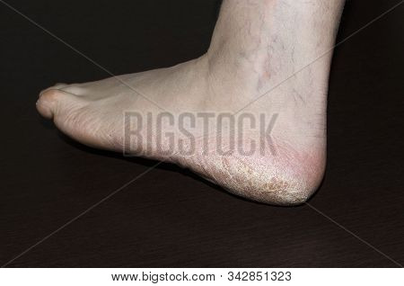 Stiffened Heel Skin On Black Background. Diasis Of Nail