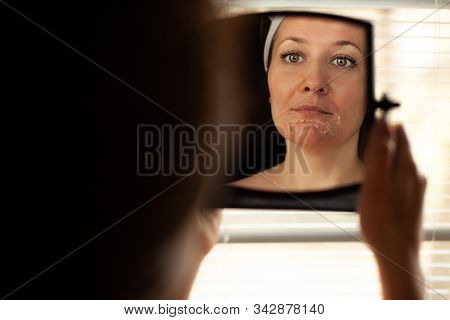 The Girl With Problem Skin Looks In The Mirror. Womans Face After Chemical Peeling. Peeling Skin On 