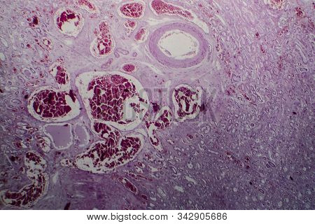 Acute Glomerulonephritis, Light Micrograph, Photo Under Microscope