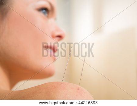 Acupuncture needle pricking on woman shoulder therapy closeup